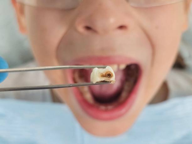 Best Emergency Gum Treatment in Chisholm, MN